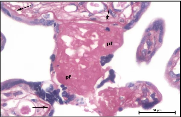 Şekil   24:  Preeklampsi   grubu   periferik   plasenta   kesiti,   kontrol   grubuna   nazaran kalınlaşmış trofoblast bazal membranı (ok), yoğun perivillöz fibrin (pf) birikimi izlenmektedir (PAS, Bar: 50μm).