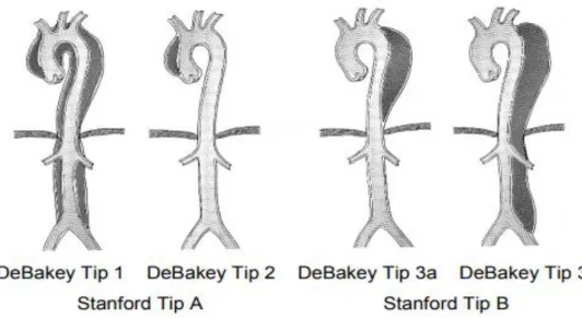 Şekil 6: Aort diseksiyonlarının sınıflandırılması [20].  2.7.  Aort Anevrizmalarında Görüntüleme Yöntemleri 