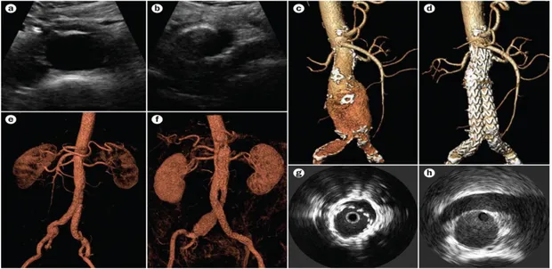 Şekil 7: AAA'lı hastaların tedavisinde kullanılan görüntüleme yöntemleri  a: Ultrasonografi, damarın çapını gösteren distal aortanın enine bir görüntüsü b:  Aortik bifurkasyonun 