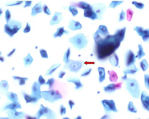 Şekil 7: Normal nükleus boyutuna sahip skuamöz hücrede perinükleer halo(kırmızı ok), x400