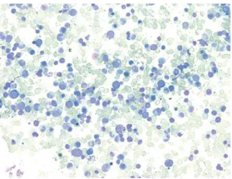 Figure 1. Bone marrow Aspirate showed megaloblastic  erythroid hyperplasia with plasmacytosis (Leishman stain  × 100X)
