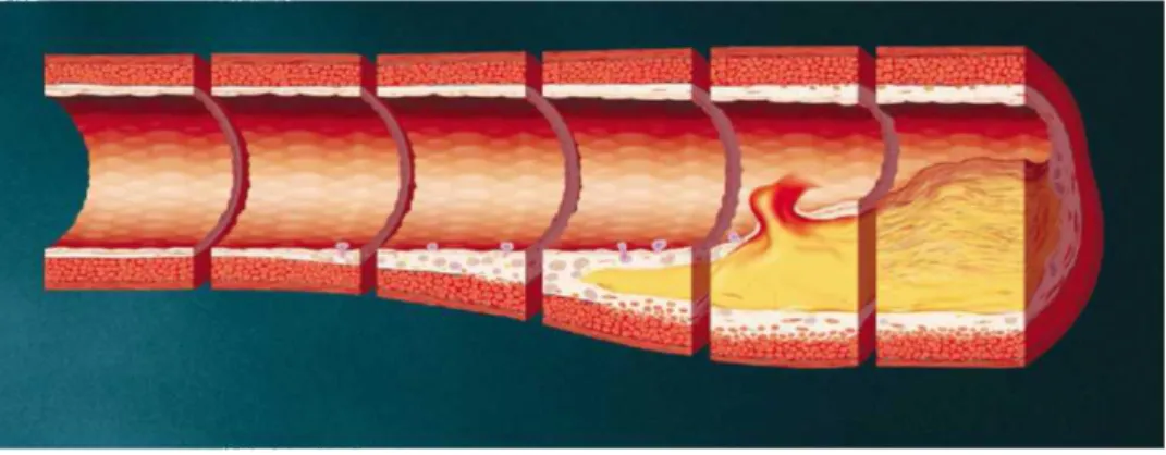 Şekil 3.1. İntima-media kalınlaşması ve aterom plağı. Libby P. Circulation 2001;104:365-372
