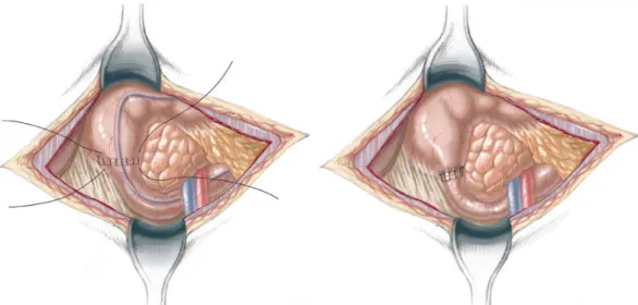 Şekil   7. Basit duodenoduodenestomi(Springer Surgery)