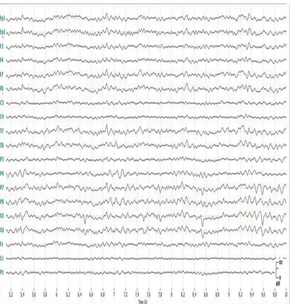 Şekil 1.2. Yüzey elektrotları aracılığıyla farklı kanallardan alınmış örnek EEG kayıtları 