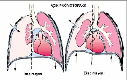 Şekil 2. Açık Pnömotoraks (50)