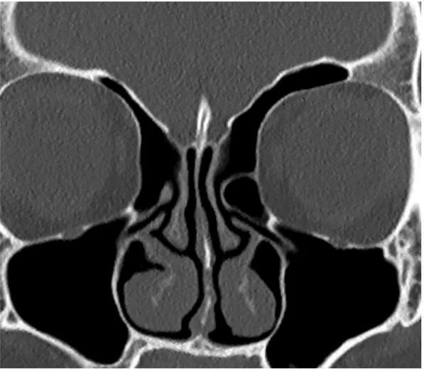 Şekil   1-   Supraorbital   pnömatizasyon,   krista   galli,   lamina   perpendikülaris,   orta konkanın   etmoid   çatıya   tutunduğu   yer,   olfaktör   oluk   ve   lamina   papriseayı   gösteren koronal reformat BT kesiti (Dr