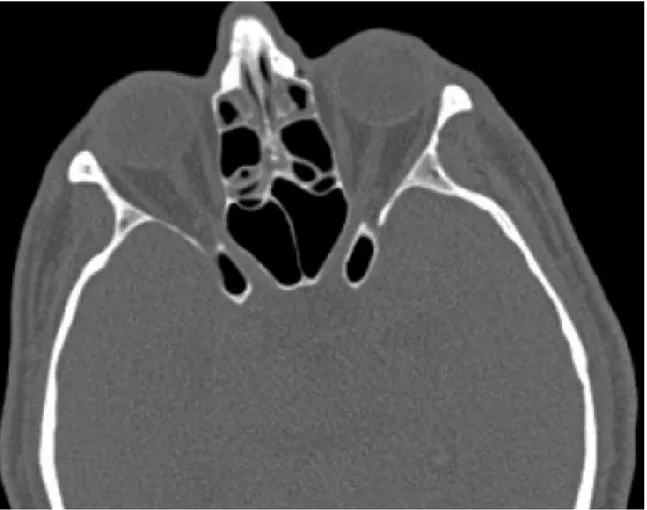 Şekil 3- Klinoid proçes havalanması.A- Bilateral anterior klinoid proçes havalanması (oklar) bulunan 55 yaşında erkek olgu.