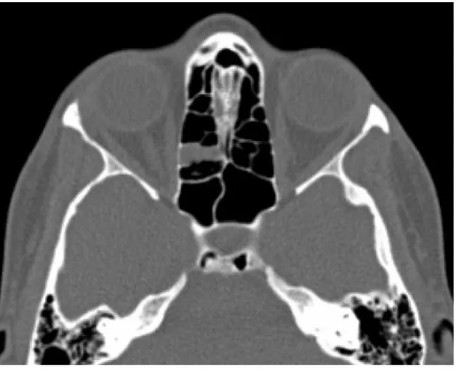 Şekil 3B- Bilateral posterior klinoid proçes havalanmasını (oklar) gösteren aksiyal BT görüntüsü.