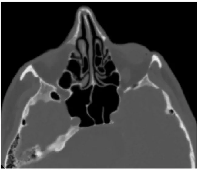 Şekil   4-   Sağ   ICA’nın   ve   optik   sinirin   sfenoid   sinüs   içerisine   protrüzyonu   ve dehisensisi.A- Sağ ICA’da sfenoid sinüs içerisine protrüzyonu ve kemik dehisensisiyi bir arada gösteren aksiyel BT görüntüsü (ok).