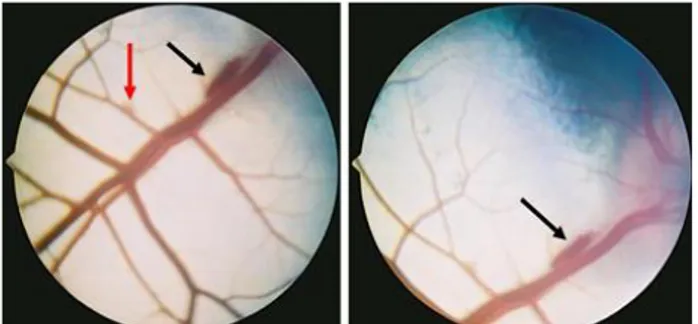 Şekil 2. Korioretinitise bağlı retinada kanama (siyah oklar), damar-