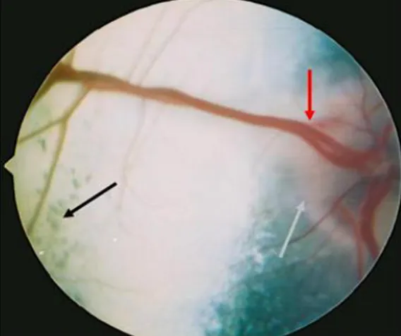 Şekil  3.  Papilloödem  (açık  gri  ok),  retinal  dejenerasyon  (siyah  ok), 