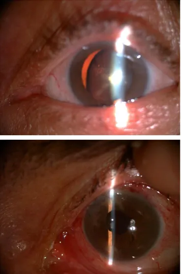 Şekil  1:  A:  Altmış  yaşında  kadın  hastanın  ameliyat  öncesi  sol  gözünün görünümü