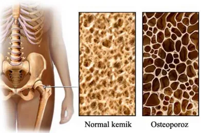 Şekil 2.2 Normal kemik yapısı ve Osteoporoz 