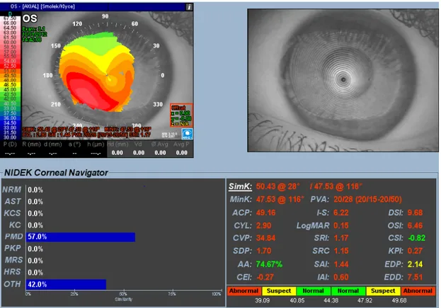 Şekil 7: Keratokonus hastamızda Nidek Magellan Mapper cihazı ile ölçülmüş yüksek I-S değeri ve düzensiz mirler 