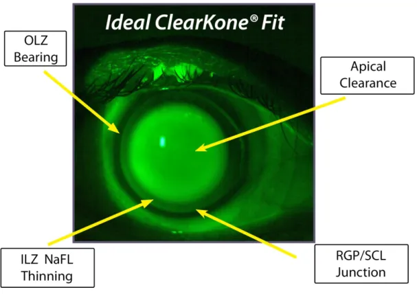 Şekil 22: İdeal clearkone görüntüsü (floreseinli görünüm)