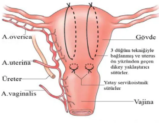 Şekil 5: Uterusu açmaksızın atılan Hayman uterus bası sütürü (61).