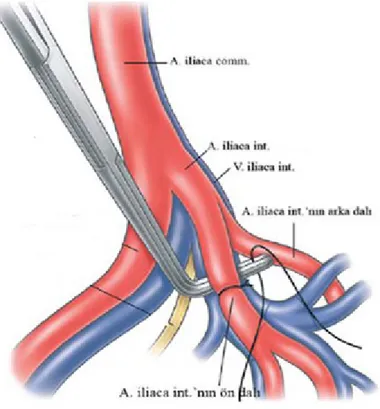 Şekil   7:   İnternal   iliyak   arterin   ön   dalının   bağlanmasının   venle   olan   ilişkisi