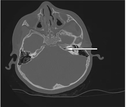 Şekil 5: Bilgisayarlı tomografide normal koklea görünümü (beyaz ok:koklea)                                                                      