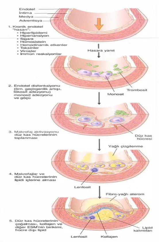 Şekil 3. Aterogenezde hasara cevap: 1,   Normal. 2,   Monosit ve   Trombosit adezyonu  ile  endotel hasarı