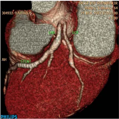 Şekil 4. Sol ana koroner arter mevcut olmayıp, LAD ve LCX sol koroner ostiumdan  ayrı olarak çıkmakta olduğunu gösteren A
