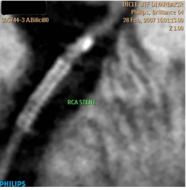 Şekil 10. Neointimal Hiperplazi A. RCA proksimalindeki patent stent distalinde  neointimal hiperplaziye ait MPR görünümü