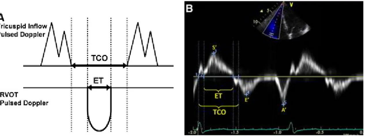 Şekil  5.  RV  MPI  nin  A)  Pulsed  Doppler  metodu  ve  B)  Doku  Doppler  metodu  ile 