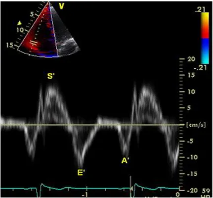 Şekil 8. RV S’ dalgasının doku Doppler ile görüntülenmesi  