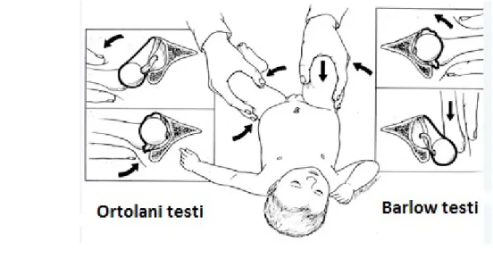 Şekil 5: Ortolani ve Barlow testleri