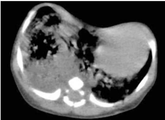 Figure 4. Second contrast-enhanced computed tomogra- tomogra-phy scan; multiple small cystic filled with air in the middle  lobe of the lung and position of the heart was normal