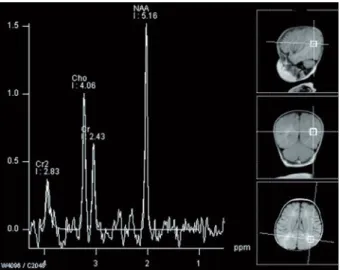 Figure 3.  MRI  spectroscopy  image  of  white  matter  in 