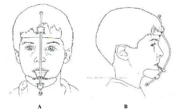 Şekil 2: Hastaya uygulanan Petit yüz maskesinin frontal (A) ve lateral (B)