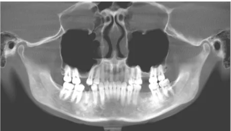 Şekil 20: Bilateral sinüs yükseltme operasyonu yapılacak                             olan hastanın 3D panoramik görüntüsü 