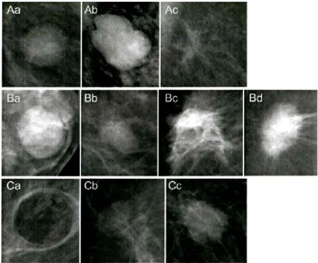 Şekil 3. Mamografık BI-RADS terminolojisine göre kitlelerin şekil, kenar ve dansite  özellikleri.