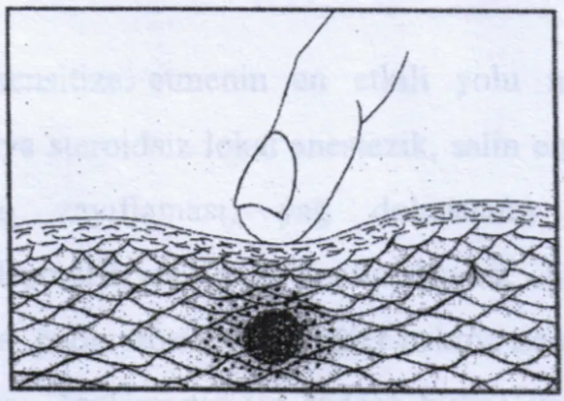 Şekil 3a:  Gergin bantın ve tetik noktanın düz palpasyon ile muayenesi.