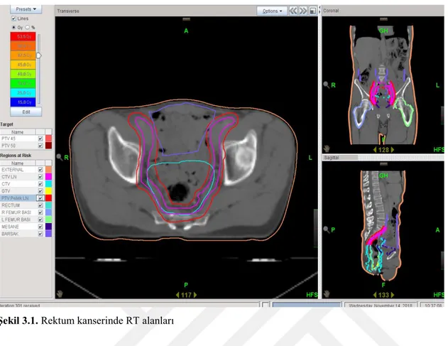 Şekil 3.1. Rektum kanserinde RT alanları 