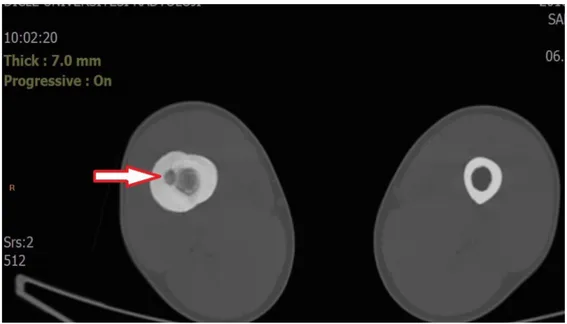 Şekil 8. Nidus ve çevresindeki sklerozun bilgisayarlı tomografideki görünümü