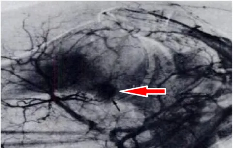 Şekil  11. Humerus boynundaki nidusun arteriografik çalışmadaki görünümü