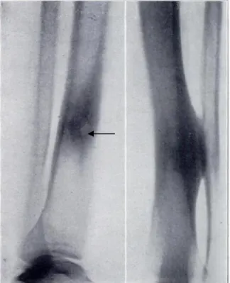 Şekil 5: Nidus ve çevresindeki sklerozun radyografik görünümü