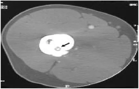 Şekil 6: Nidus ve çevresindeki sklerozun bilgisayarlı tomografideki  görünümü