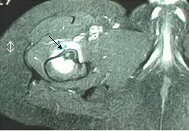 Şekil 7: Nidus ve çevresindeki sklerozun MRI ’deki görünümü