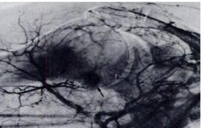Şekil 9: Humerus boynundaki nidusun arteriografik çalışmadaki görünümü