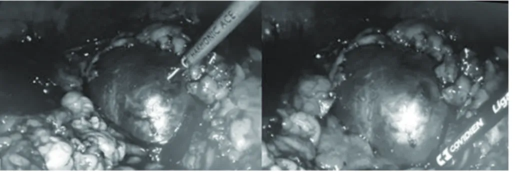 Figure 2. Renal cyst excision 