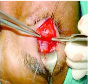Figure  2.  Insertion  of  the  suture  from  the 