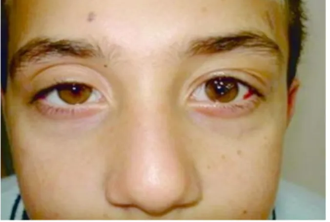 Figure 4. Postoperative image of the eyes a case. 
