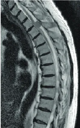 Figure 2. Lobulated and whorled aggregates of polygo- polygo-nal to epithelioid tumor cells, some partly bounded by thin  collagenous septa