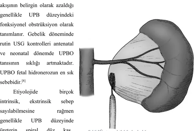 Şekil 5Üreteropelvik bileşke darlığı