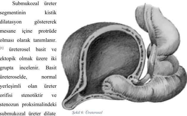 Şekil 6: Üreterosel