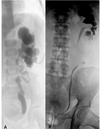 Şekil 8 A: Antegrad Pyelografi B:Retrograd Pyelografi