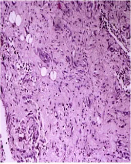 Şekil 8. Mikroskopik grade 1.                           Şekil 9. Mikroskopik grade 2.