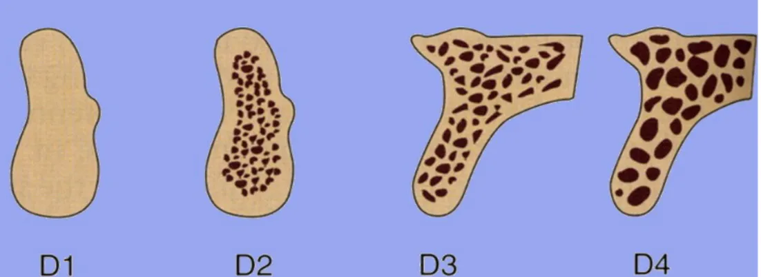 Şekil 2.2.  Misch’in alveoler kemiğiin makroskobik kompakt veya trabeküler karakteristik özelliklerine göre yaptığı sınıflama